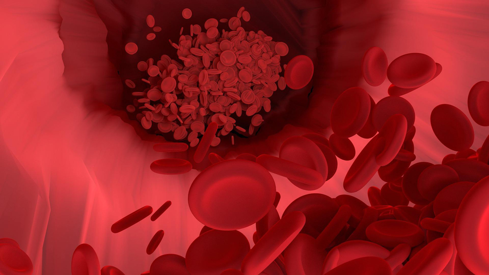 hemophilia A