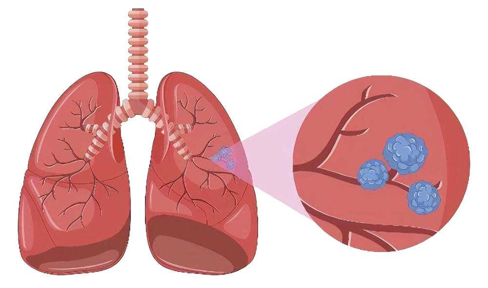 pulmonary sarcoidosis