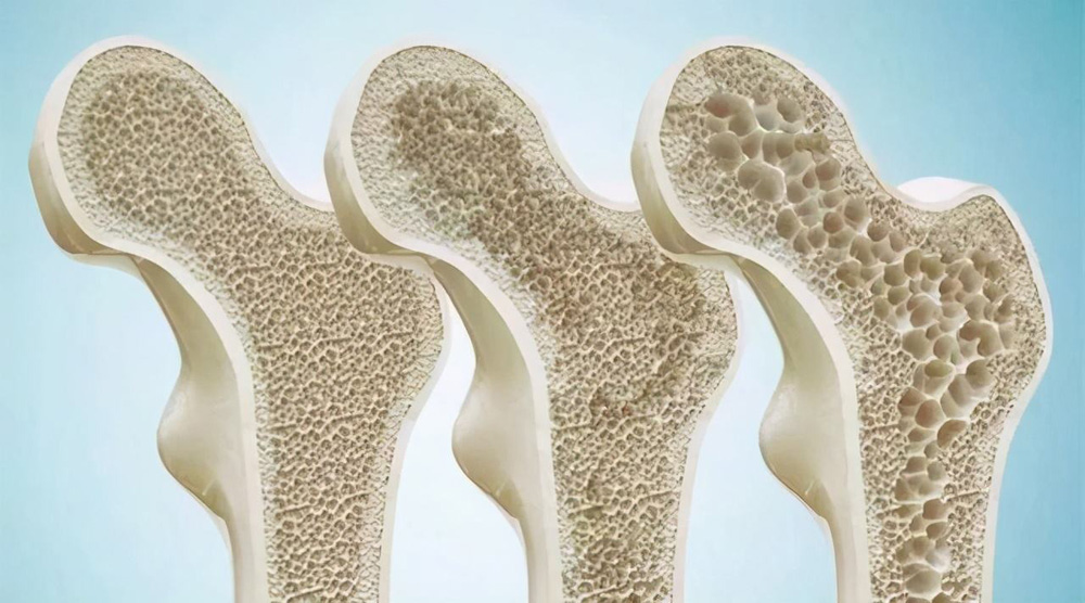 osteoporosis