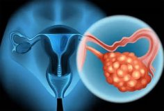 ovarian cancer